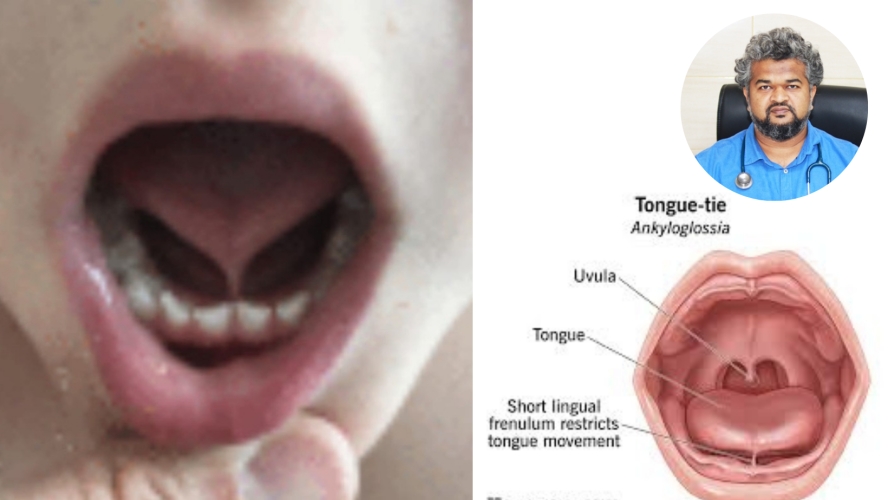 জিহবা আটকানো (Tongue tie) ডাঃ আব্দুল্লাহ-আল-মামুন এমবিবিএস, বিসিএস (স্বাস্থ্য) এমএস (পেডিয়াট্রিক সার্জারি)